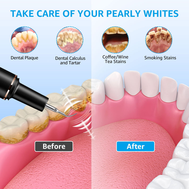 Teeth Cleaning Kit Plaque Remover for Teeth, Portable Dental Plaque Remover Tool with LED, Plaque Blaster for Human Teeth with 3 Modes, Tooth Scraper Plaque Tartar Remover for Teeth with Dental Tools Black - PawsPlanet Australia